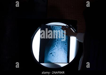 Die Skoliose der Wirbelsäule wird vom Arzt auf dem Röntgenbild des Patienten untersucht, das die menschliche Anatomie der Knochen in der Seitenansicht des jungen Erwachsenen zeigt Stockfoto