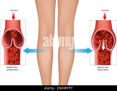 Venenerkrankungen oder Varikosen und Herzklappenfehler. Chronisch venöse Insuffizienz oder venöser Reflux. Stock Vektor