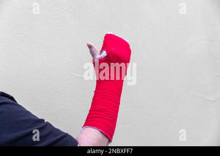 Gebrochenes Armknochen im Guss (rot) Stockfoto