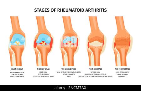 Realistische Infografiken zur Darstellung von vier Stadien der rheumatoiden Arthritis des Kniegelenkes Stock Vektor