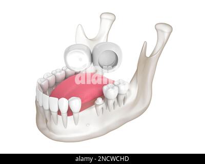 3D-Darstellung des Unterkiefers mit dentaler Kragarmbrücke auf weißem Hintergrund Stockfoto