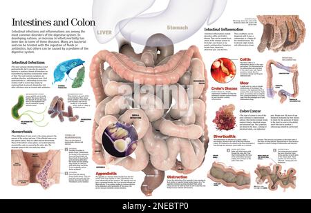 Infografik der häufigsten Erkrankungen des Dickdarms und des Darmes wie Hämorrhoiden, Appendizitis oder Darmentzündung. [QuarkXPress (.qxp); 6259x4015]. Stockfoto