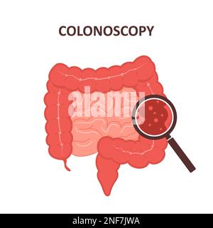 Koloskopie-Konzept. Darmuntersuchung und -Behandlung. Kolonpolypektomie. Krebsvorsorge. Vektordarstellung im flachen Cartoon-Stil Stock Vektor