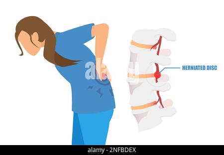 Vektor einer jungen Frau mit Rückenschmerzen und Ischias aus einem Bandscheibenvorfall. Stock Vektor