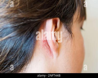 Reizung der Haut hinter dem Ohr. Mann mit schuppiger Haut. Allergie oder Pilzkrankheit. Stockfoto
