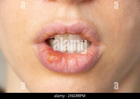 Simplex Herpes auf den Lippen eines Mädchens Nahaufnahme, eine Gruppe von Viruserkrankungen mit einem charakteristischen Ausschlag von gruppierten Vesikeln auf der Lippe Stockfoto