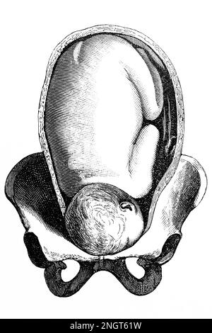 Abnorme Lage des Feten. Gesichtspräsentation. Antike Illustration aus einem Medizinbuch. 1889. Stockfoto