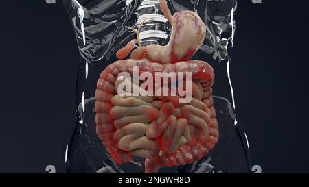 Mann mit Crohns-Krankheit, männliche Anatomie, entzündeter Dickdarm, Sigmoid Colon, Teile des menschlichen Verdauungssystems, 3D-Rendern Stockfoto
