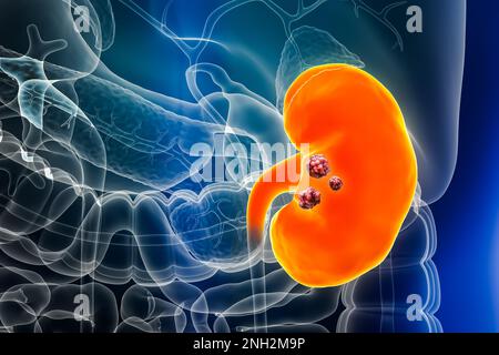 Nieren- oder Nierenbeckenkrebs mit Organen und Tumoren oder Krebszellen 3D-Darstellung. Anatomie, Onkologie, Biomedizin, Nephrologie, Krankheit, Stockfoto