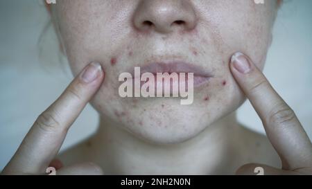 Nahaufnahme von Hautproblemen, ungesunde Haut mit Akne und Pickel. Porös, Demodex und Rosazea, rote Ausschläge. Das Konzept der Pflege der Problemhaut. Allerg Stockfoto