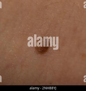 Großer Muttermal auf dem Körper einer Frau, Medizin, Gesundheit Stockfoto