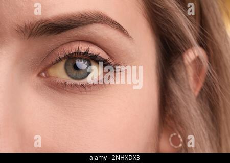 Frau mit gelben Augen, Nahaufnahme. Symptom Leberprobleme Stockfoto
