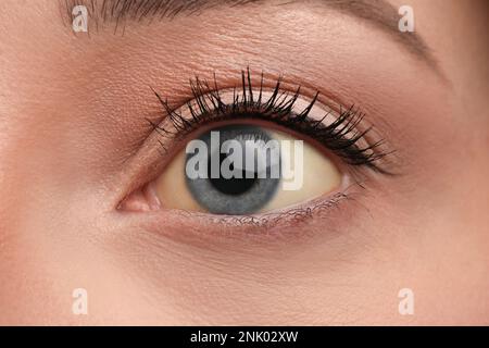 Frau mit gelben Augen als Hintergrund, Nahaufnahme. Symptom Leberprobleme Stockfoto