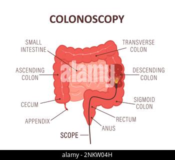 Koloskopie-Konzept. Darmuntersuchung und -Behandlung. Darmpolypektomie. Zur Anatomie des Kolons. Krebsvorsorge. Vektordarstellung flach Stock Vektor