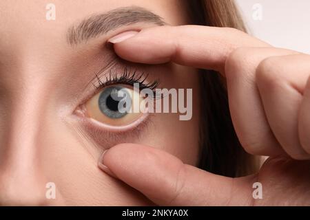Frau mit gelben Augen, Nahaufnahme. Symptom Leberprobleme Stockfoto
