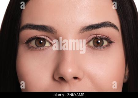 Frau mit gelben Augen als Hintergrund, Nahaufnahme. Symptom Leberprobleme Stockfoto