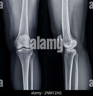 Röntgenfilm des linken Kniegelenkes in AP- und Lateralansicht zur Diagnostik von Knieschmerzen bei Osteoarthritis und Fraktur. Stockfoto