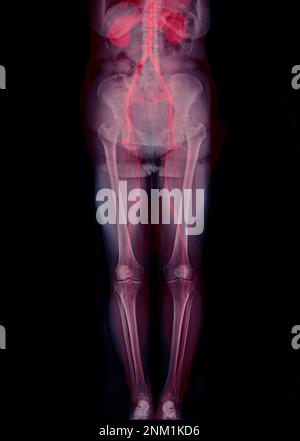 CTA-Ablauf der Femoralarterie zeigt Femoralarterie für die Diagnose akuter oder chronischer peripherer arterieller Verschlusskrankheit. Stockfoto