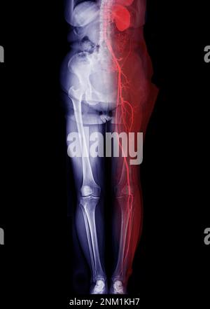 CTA-Ablauf der Femoralarterie zeigt Femoralarterie für die Diagnose akuter oder chronischer peripherer arterieller Verschlusskrankheit. Stockfoto