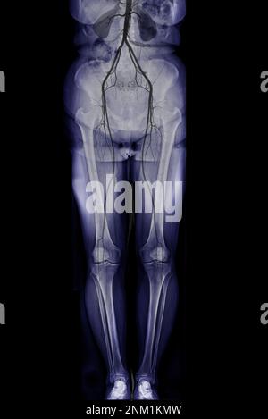 CTA-Ablauf der Femoralarterie zeigt Femoralarterie für die Diagnose akuter oder chronischer peripherer arterieller Verschlusskrankheit. Stockfoto