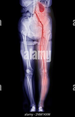 CTA-Ablauf der Femoralarterie zeigt Femoralarterie für die Diagnose akuter oder chronischer peripherer arterieller Verschlusskrankheit. Stockfoto