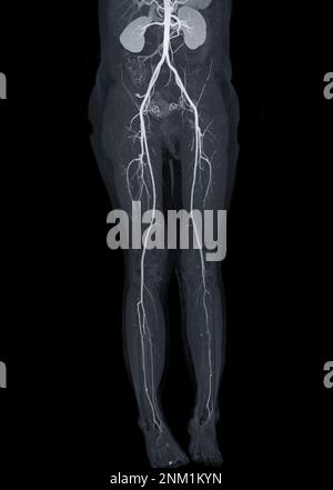 CTA-Ablauf der Femoralarterie zeigt Femoralarterie für die Diagnose akuter oder chronischer peripherer arterieller Verschlusskrankheit. Stockfoto