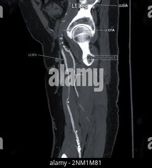 CTA der Arteria femoralis: Abfluss von der MPR-Kurve, die die linke Femoralarterie für die Diagnose einer akuten oder chronischen peripheren arteriellen Verschlusskrankheit zeigt. Stockfoto