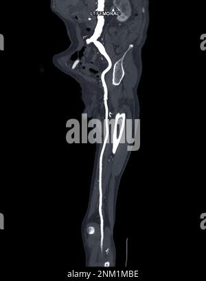 CTA der Arteria femoralis: Abfluss von der MPR-Kurve, die die linke Femoralarterie für die Diagnose einer akuten oder chronischen peripheren arteriellen Verschlusskrankheit zeigt. Stockfoto