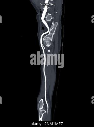 CTA der Arteria femoralis: Abfluss von der MPR-Kurve, die die linke Femoralarterie für die Diagnose einer akuten oder chronischen peripheren arteriellen Verschlusskrankheit zeigt. Stockfoto