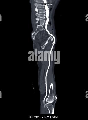 CTA der Arteria femoralis: Abfluss von der MPR-Kurve, die die linke Femoralarterie für die Diagnose einer akuten oder chronischen peripheren arteriellen Verschlusskrankheit zeigt. Stockfoto