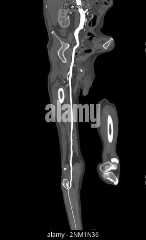 CTA der Arteria femoralis Abfluss von der MPR-Kurve, die die rechte Arteria femoralis für die Diagnose einer akuten oder chronischen peripheren arteriellen Verschlusskrankheit zeigt. Stockfoto