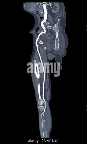 CTA der Arteria femoralis Abfluss von der MPR-Kurve, die die rechte Arteria femoralis für die Diagnose einer akuten oder chronischen peripheren arteriellen Verschlusskrankheit zeigt. Stockfoto