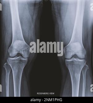 Röntgenfilm-Röntgenaufnahme beider Kniegelenke AP-Ansichtsname ist Rosenberg-Ansicht zur Diagnose von Knieschmerzen bei Osteoarthritis und Fraktur. Stockfoto