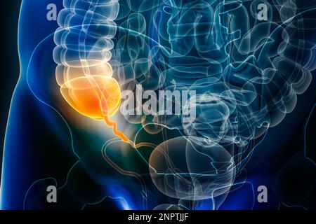 Appendizitis-Krankheit oder vermiforme Appendixentzündung 3D Darstellung. Anatomie, Chirurgie, biomedizinisch, Krankheit, medizinisch, Biologie, Wissenschaft, h Stockfoto