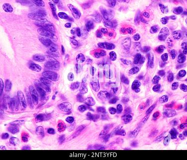 Lichtmikroskopische Darstellung eosinophiler Granulozyten in der Lamina propria einer entzündeten Appendix. Diese Zellen enthalten reichlich rote Granula ( Stockfoto