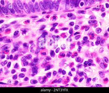 Lichtmikroskopische Darstellung eosinophiler Granulozyten in der Lamina propria einer entzündeten Appendix. Diese Zellen enthalten reichlich rote Granula ( Stockfoto