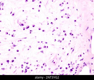 Plasmazellen sind B-Lymphozyten, die durch die Anwesenheit von Antigenen aktiviert werden, die große Mengen von Antikörpern absondieren. Sie treten in Geweben auf, die von c betroffen sind Stockfoto