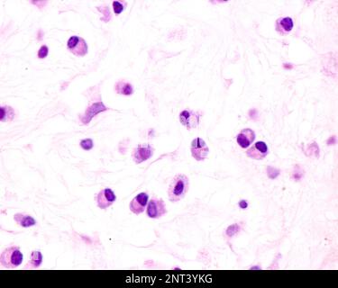 Plasmazellen sind B-Lymphozyten, die durch die Anwesenheit von Antigenen aktiviert werden, die große Mengen von Antikörpern absondieren. Sie treten in Geweben auf, die von c betroffen sind Stockfoto