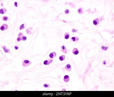 Plasmazellen sind B-Lymphozyten, die durch die Anwesenheit von Antigenen aktiviert werden, die große Mengen von Antikörpern absondieren. Sie treten in Geweben auf, die von c betroffen sind Stockfoto