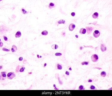 Plasmazellen sind B-Lymphozyten, die durch die Anwesenheit von Antigenen aktiviert werden, die große Mengen von Antikörpern absondieren. Sie treten in Geweben auf, die von c betroffen sind Stockfoto