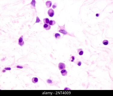 Plasmazellen sind B-Lymphozyten, die durch die Anwesenheit von Antigenen aktiviert werden, die große Mengen von Antikörpern absondieren. Sie treten in Geweben auf, die von c betroffen sind Stockfoto