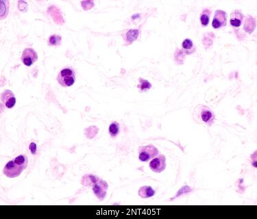 Plasmazellen sind B-Lymphozyten, die durch die Anwesenheit von Antigenen aktiviert werden, die große Mengen von Antikörpern absondieren. Sie treten in Geweben auf, die von c betroffen sind Stockfoto