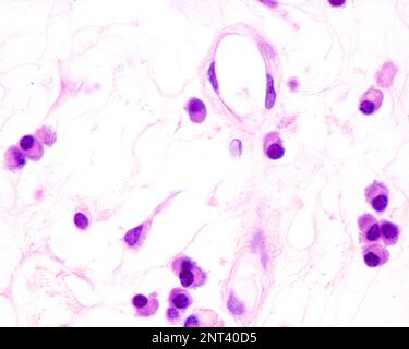 Plasmazellen sind B-Lymphozyten, die durch die Anwesenheit von Antigenen aktiviert werden, die große Mengen von Antikörpern absondieren. Sie treten in Geweben auf, die von c betroffen sind Stockfoto