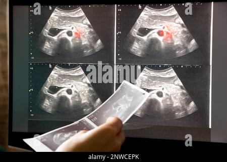 Ultraschall des Abdomens einer Frau auf einem Laptop-Monitor in einer Arztpraxis, Diagnose von Bauchschmerzen, Medizin Stockfoto