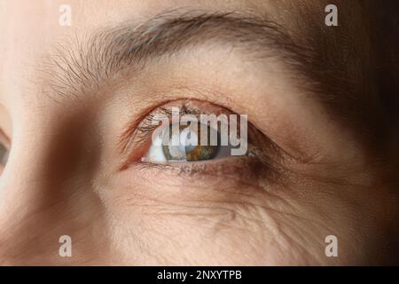 Nahaufnahme einer reifen Frau mit Katarakt Stockfoto