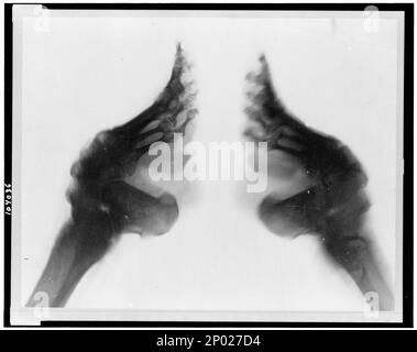 Röntgenbild der gefesselten Füße, China. Frank and Frances Carpenter Collection, Radiography, 1890-1930, Feet, 1890-1930, Footbinding, China, 1890-1930. Stockfoto