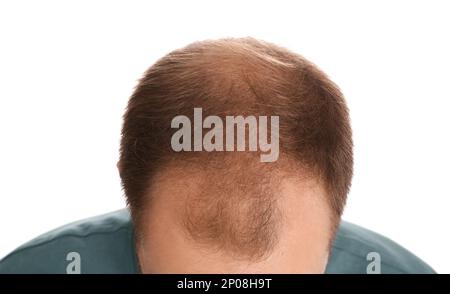 Mann mit Haarausfall auf weißem Hintergrund, Nahaufnahme. Trichologische Behandlung Stockfoto