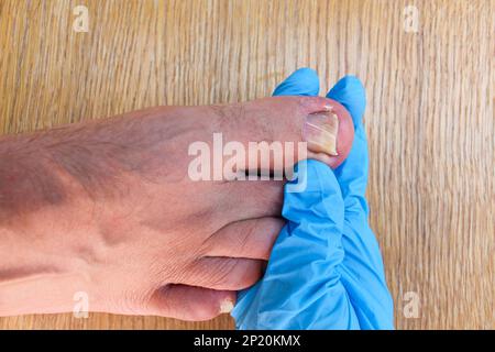 Eingewachsene Zehennagel zu Fuß. Arzt untersucht die Daumen. Stockfoto