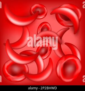 Sichelzellkrankheit. SCD. Normale Erythrozyten und Sichelzellen im Blutfluss. Roter Hintergrund. Anämie oder Anämie. Erkrankungen des Blutes. Vektorposter Stock Vektor