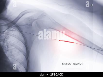 Angioplastie, Ballonangioplastie und perkutane transluminale Angioplastie (PTA) am linken Arm. Stockfoto